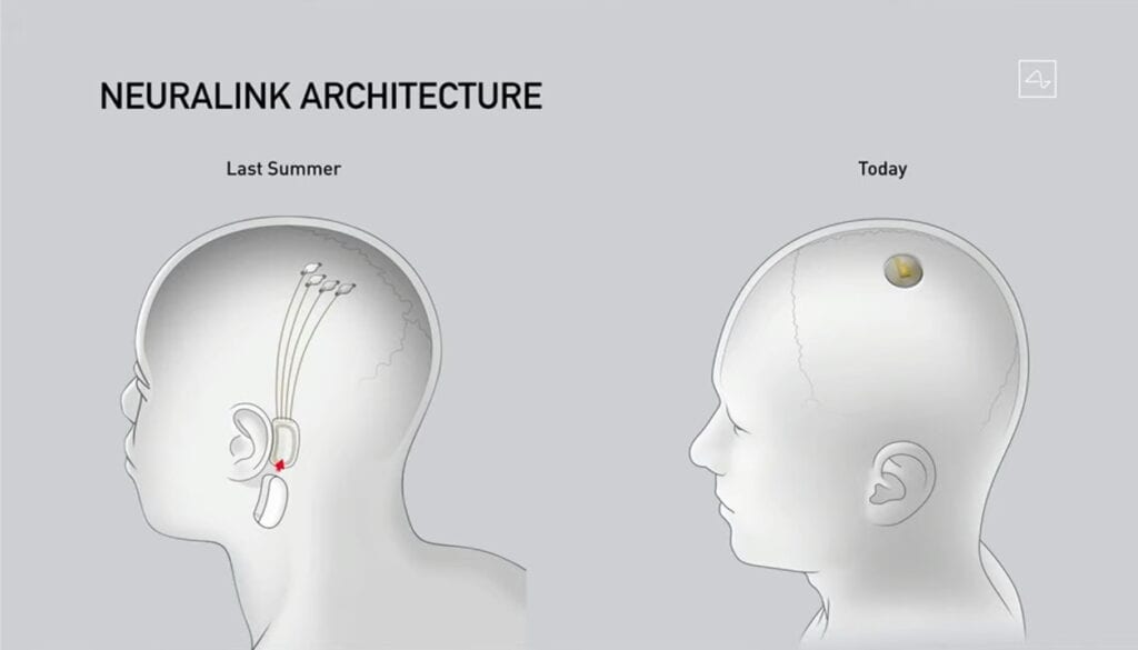 Neuralink technology
